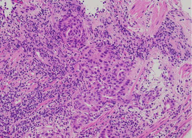 Synchronous Double Primary Lung Adenocarcinomas With <i>EGFR</i> L858R Point Mutation and <i>MET</i> Exon 14 Skipping Mutation.