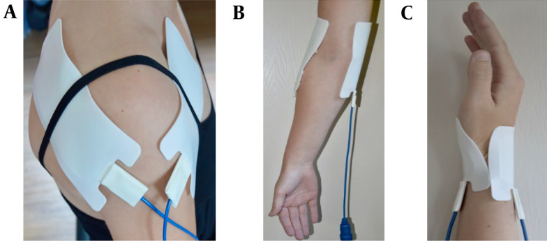 Transcutaneous Pulsed Radiofrequency Treatment in Patients with Osteoarthritis of the Upper Extremity.
