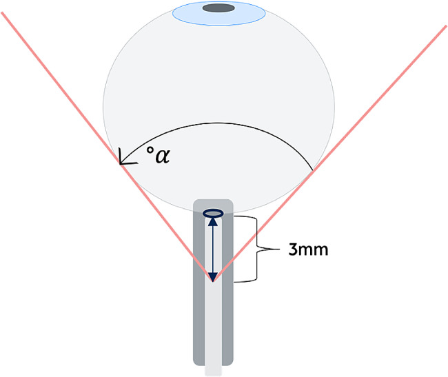 Transorbital B-mode ultrasound for the assessment of posterior globe flattening in idiopathic intracranial hypertension: a pilot study.