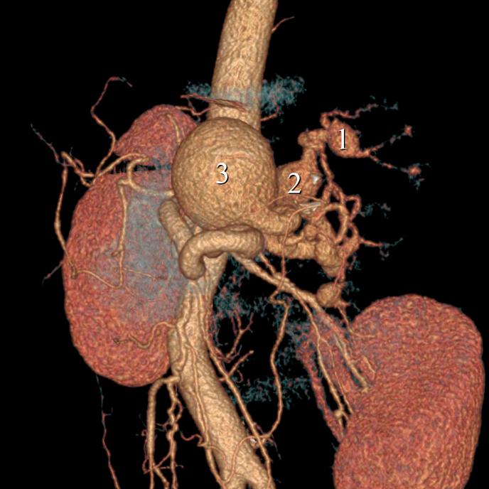 Embolization of multiple splenic artery aneurysms in a patient with hypersplenism due to portal hypertension: a case report.