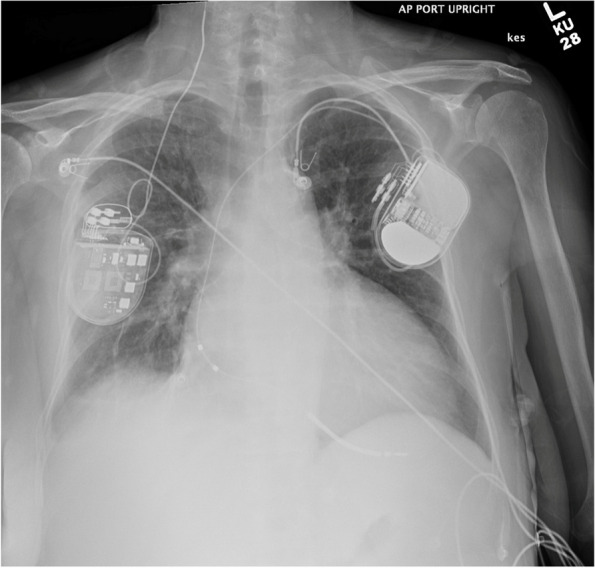 Old problem surfaces with new technology: Twiddler's syndrome in Barostim NEO.