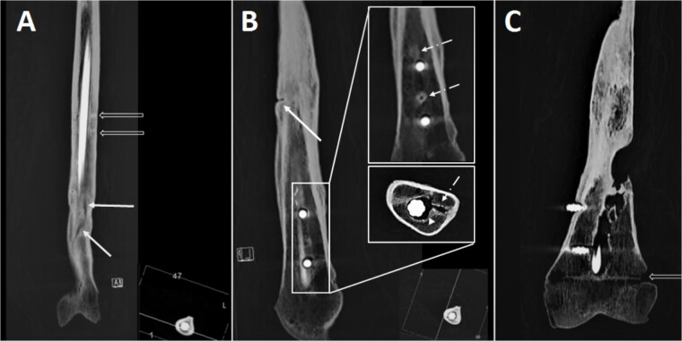 Combining anthropology and imaging to reconstruct antemortem trauma for identification purposes.