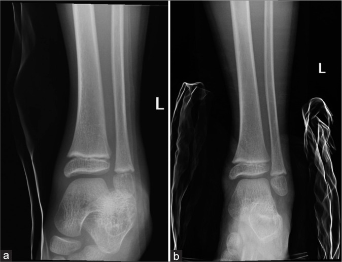 Acute traumatic subtalar dislocation: A rare but important clinical entity with 15-year retrospective radiological analysis of 23 cases.