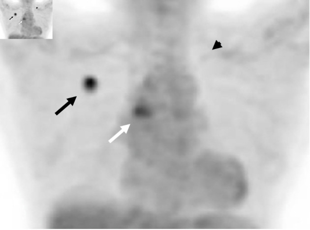 Synchronous Double Primary Lung Adenocarcinomas With <i>EGFR</i> L858R Point Mutation and <i>MET</i> Exon 14 Skipping Mutation.