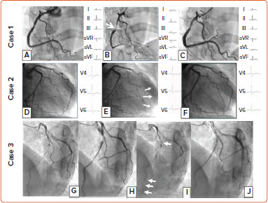 A Review of the Role of Tests of Coronary Reactivity in Clinical Practice.