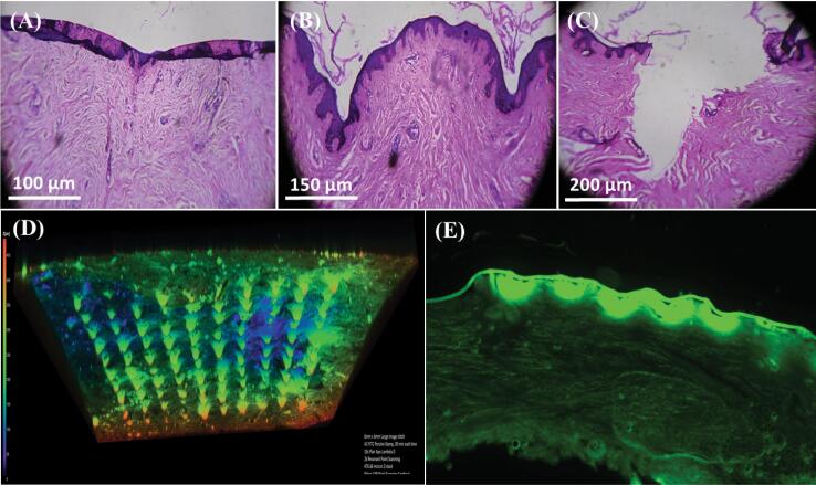 Sustained release microneedle patch for pronounced systemic delivery of doxazosin mesylate.