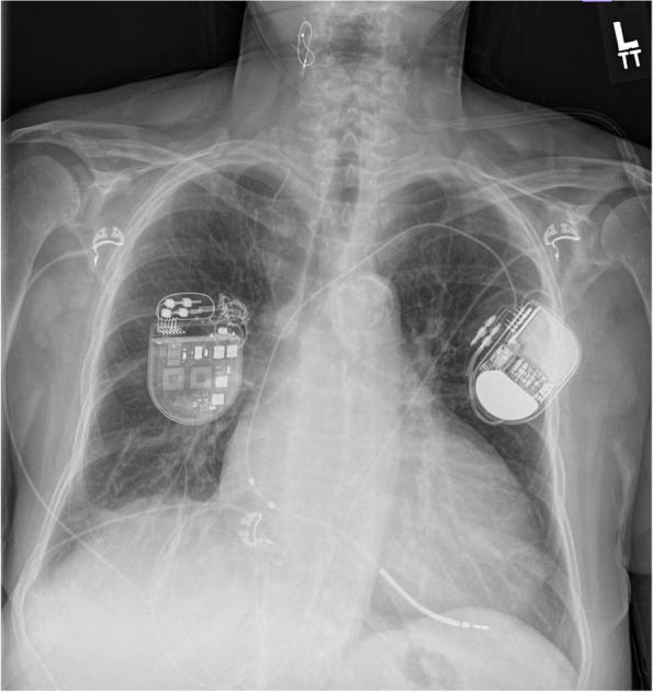 Old problem surfaces with new technology: Twiddler's syndrome in Barostim NEO.