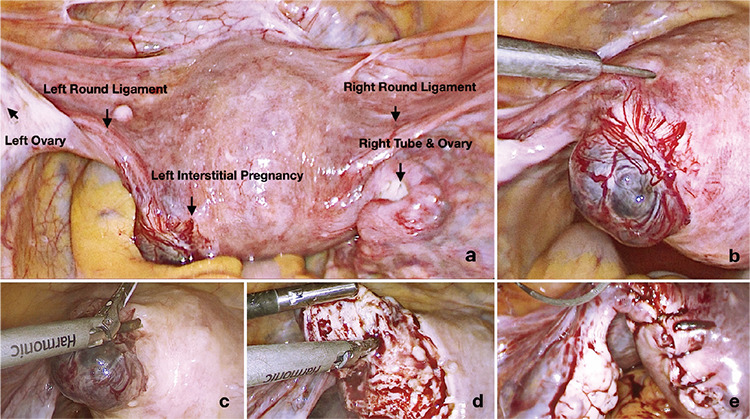Interstitial ectopic pregnancy in a patient with absent ipsilateral fallopian tube.