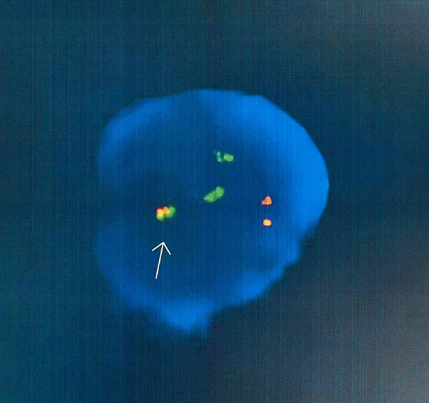 Chronic Myeloid Leukemia with a Rare Philadelphia Chromosome Variant Involving Chromosome 16.