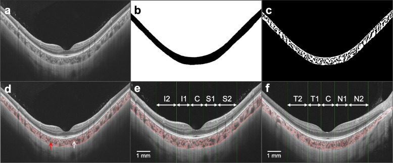 Choroidal vascular changes in early-stage myopic maculopathy from deep learning choroidal analysis: a hospital-based SS-OCT study.