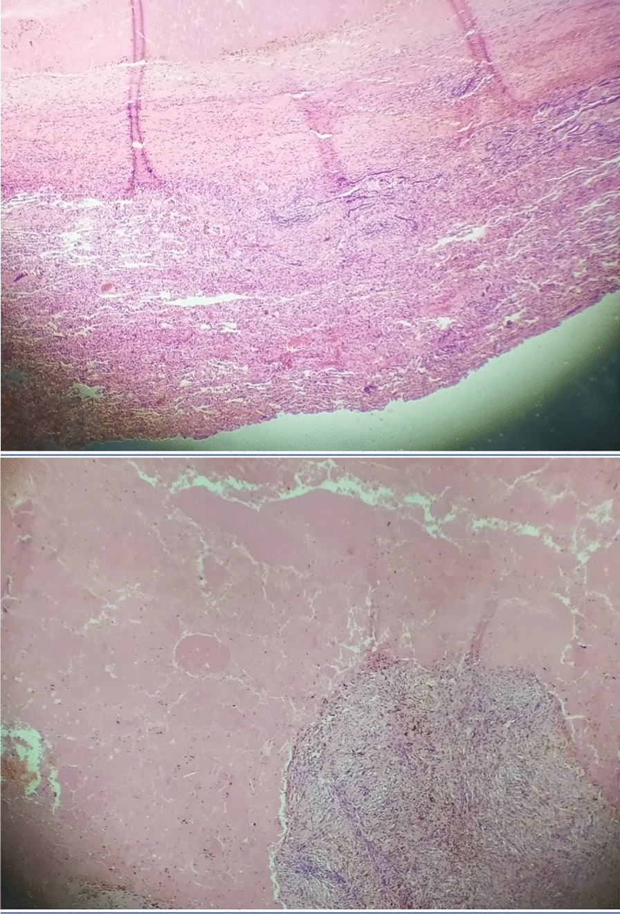 Ewing sarcoma presenting in the lung: a case report.