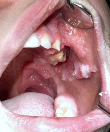 Oral sialadenoma papilliferum with kras mutation in a patient with linear nevus sebaceous syndrome.