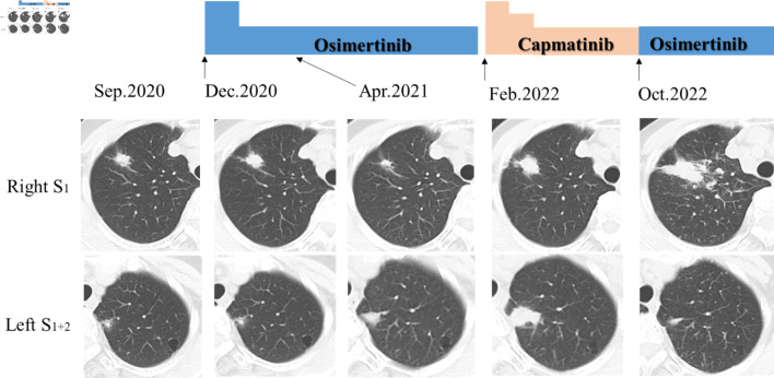 Synchronous Double Primary Lung Adenocarcinomas With <i>EGFR</i> L858R Point Mutation and <i>MET</i> Exon 14 Skipping Mutation.