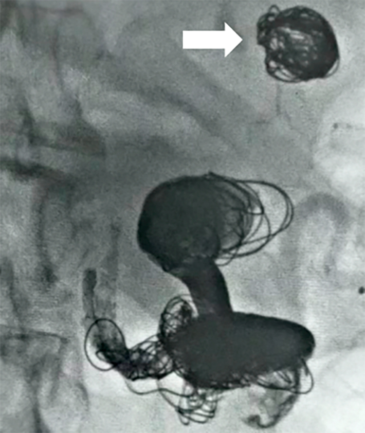 Embolization of multiple splenic artery aneurysms in a patient with hypersplenism due to portal hypertension: a case report.