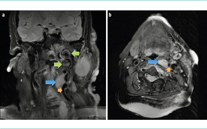[Neurovascular pathology in a patient with neurofibromatosis type 1. Case report].