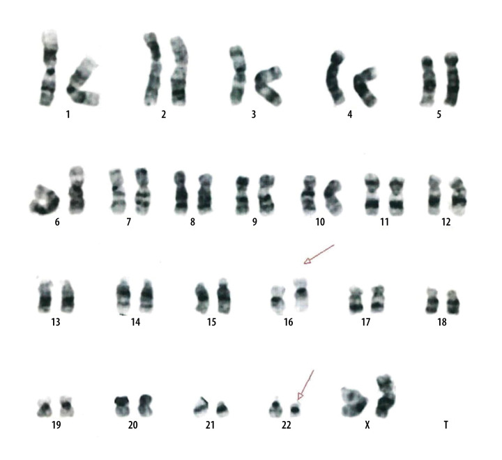 Chronic Myeloid Leukemia with a Rare Philadelphia Chromosome Variant Involving Chromosome 16.