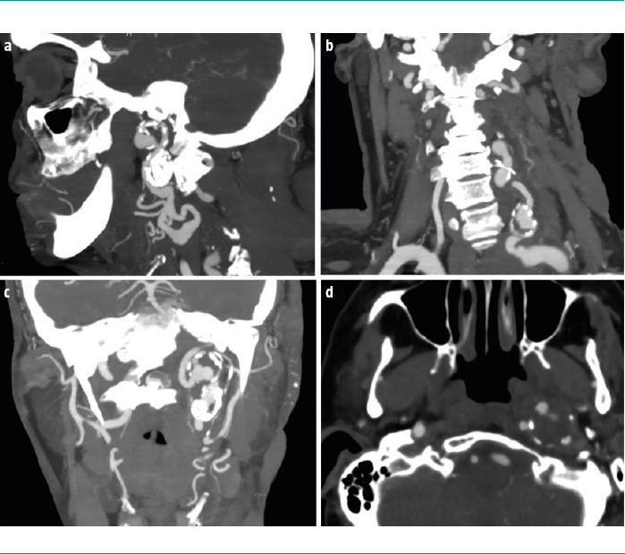 [Neurovascular pathology in a patient with neurofibromatosis type 1. Case report].