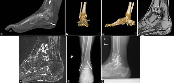 Acute traumatic subtalar dislocation: A rare but important clinical entity with 15-year retrospective radiological analysis of 23 cases.
