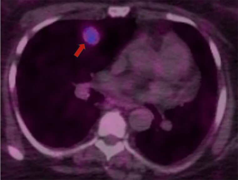 Ectopic Cushing Syndrome Secondary to Diffuse Idiopathic Neuroendocrine Cell Hyperplasia-A Report of 2 Cases.