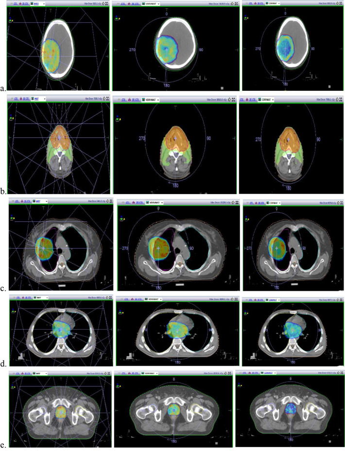 Comparison of three Radiotherapy Techniques Volumetric Modulated Arc Therapy with Variable and Constant Dose Rate and Intensity-Modulated Radiotherapy for the Irradiation of Five Cancer Sites.