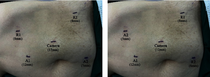 Initial Experience of Robot-Assisted Nephroureterectomy without Intraoperative Repositioning Using a New Robotic Surgical System (KD-SR-01TM).