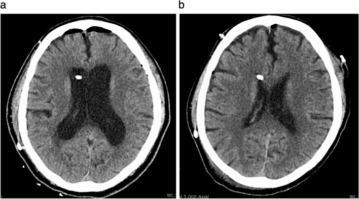 Delayed recovery of consciousness from anesthesia due to exacerbation of hydrocephalus caused by a ventriculoperitoneal shunt malfunction during general anesthesia in the prone position: a case report.