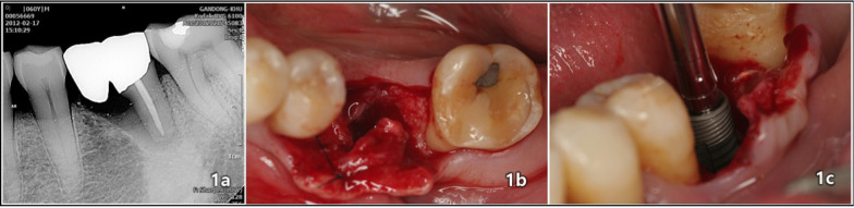 An eight-year retrospective study on the clinical outcomes of laser surface-treated implants.