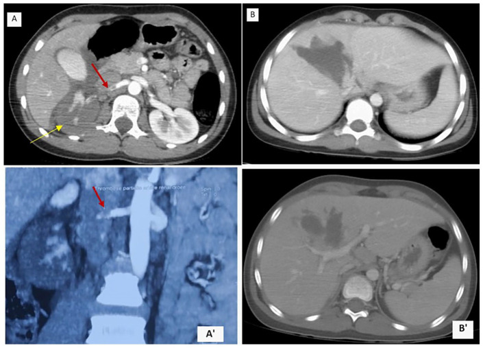 Traumatic Renal Artery Occlusion in Children: A Case Report.