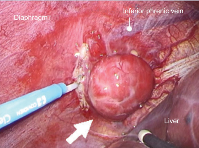 Clinical T1a Renal Cell Carcinoma with Solitary Diaphragmatic Metastasis in a Patient with von Hippel-Lindau Disease.