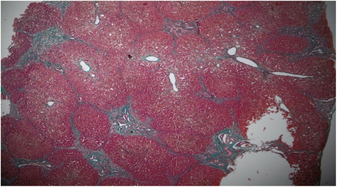 ZFYVE19 gene mutation: A novel variant of progressive familial intrahepatic cholestasis.