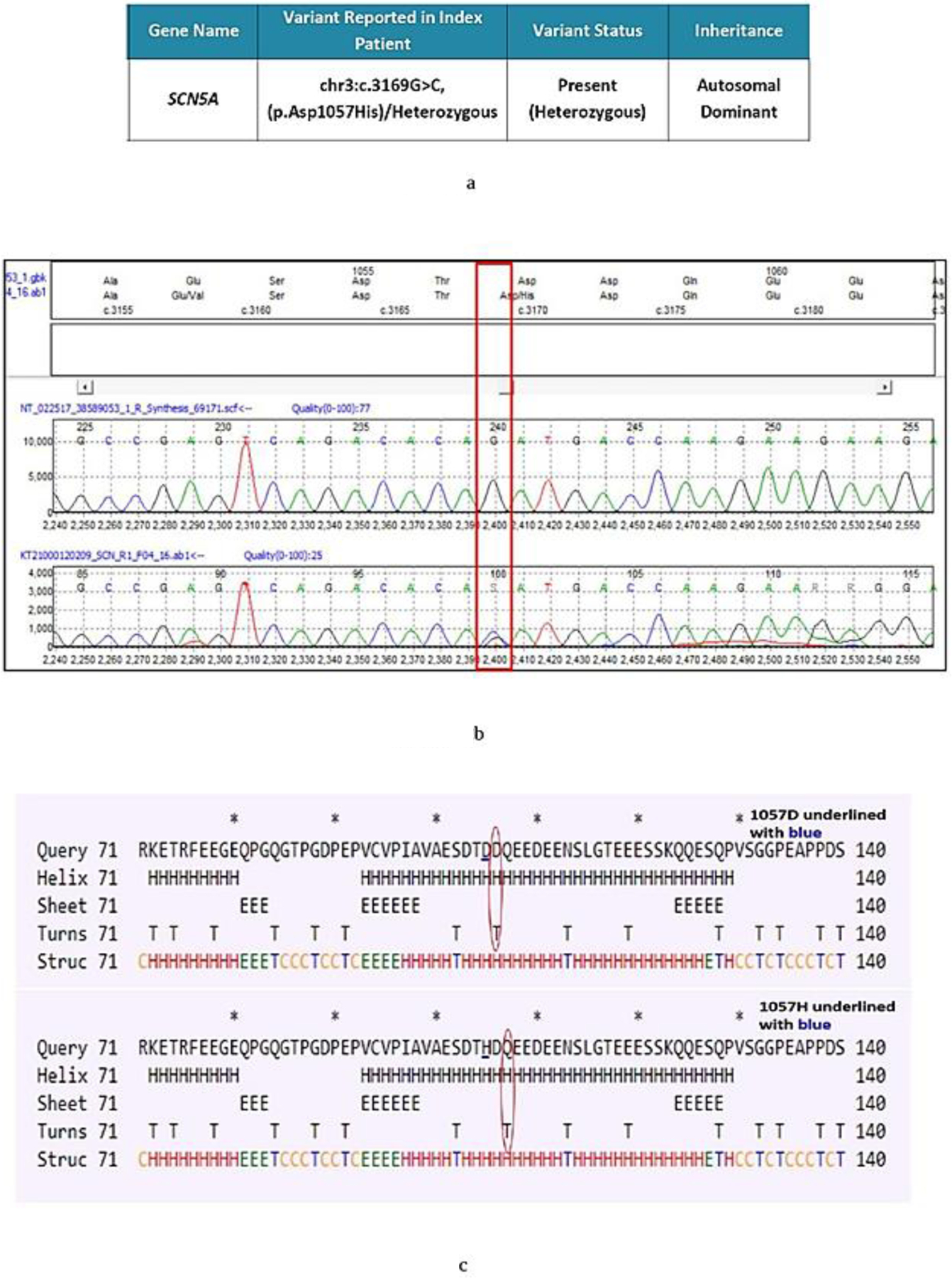 Identification of a Novel <i>SCN5A</i> gene variant in a young female with atrioventricular canal defect in the absence of classical Brugada syndrome phenotype.