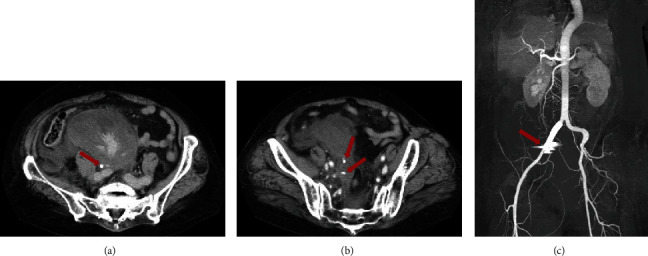 Acquired Hemophilia A Diagnosed Based on Gross Hematuria: A Case Report and Literature Review.