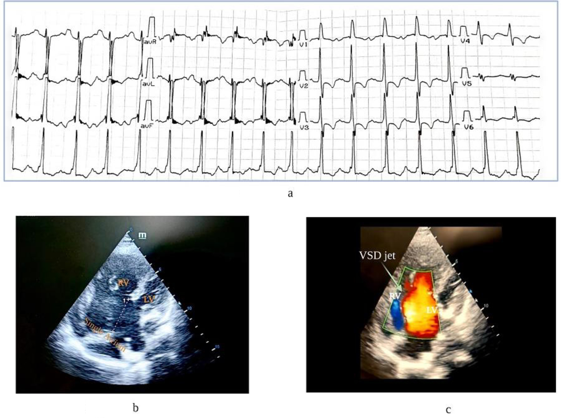 Identification of a Novel <i>SCN5A</i> gene variant in a young female with atrioventricular canal defect in the absence of classical Brugada syndrome phenotype.
