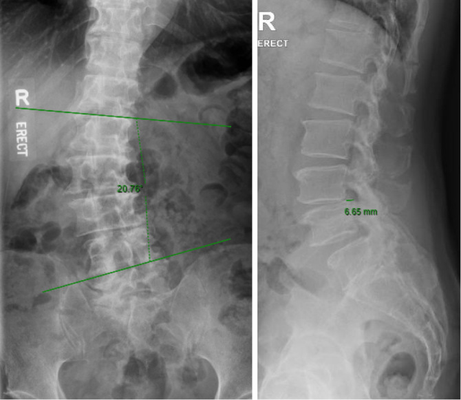Spondylolisthesis and Scoliosis Progression and Associated Revision Rates Following Bilateral Lumbar Spine Microscopic Decompression.
