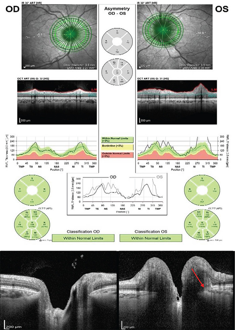 Unilateral Papilledema with Bilateral Optic Nerve Sheath Distension: A Case Report.