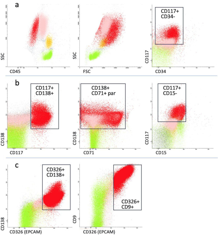 Breast Cancer With Release of Tumor Cells in Peripheral Blood Mimicking Acute Myeloid Leukemia.