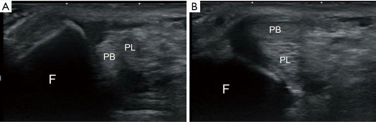 Recurrent peroneal tendon dislocation-the current concept of management.