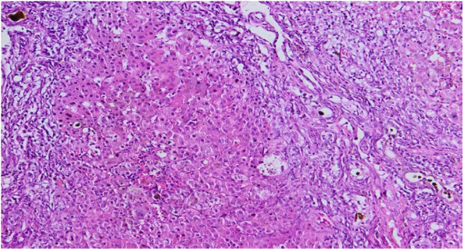 ZFYVE19 gene mutation: A novel variant of progressive familial intrahepatic cholestasis.