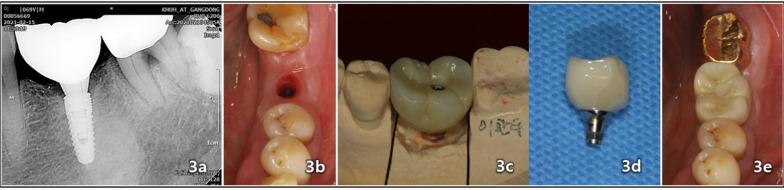 An eight-year retrospective study on the clinical outcomes of laser surface-treated implants.