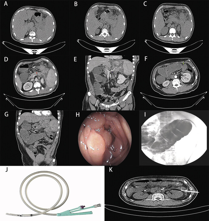 Acute Necrotizing Pancreatitis Complicated With Sinistral Portal Hypertension And Mechanical Obstruction Of The Colon: A Case Report.