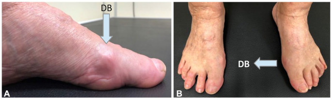 Good Short- and Mid-term Outcome After Cross-Linked Hyaluronic Acid Infiltration for Hallux Rigidus: A Case Report.