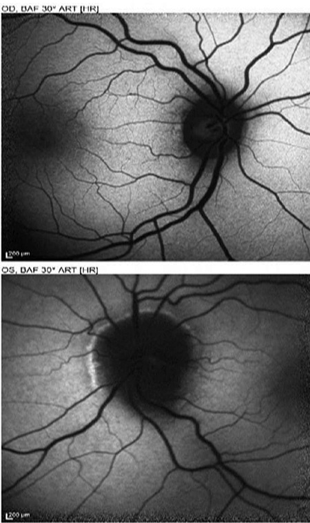 Unilateral Papilledema with Bilateral Optic Nerve Sheath Distension: A Case Report.
