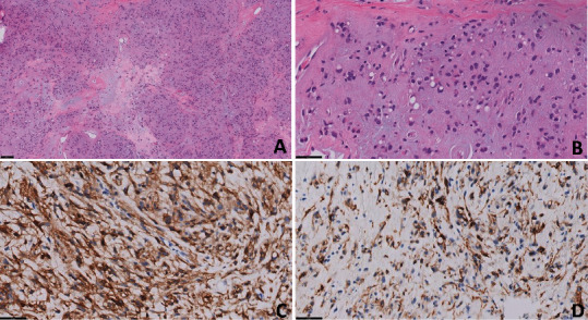 First Description of the Clinical Activity of Avapritinib in Sporadic Mesenteric Desmoid Tumor.