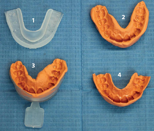 Prevention of Oral Injuries during Endotracheal Intubation: Patients' and Anesthesiologists' Perspective.