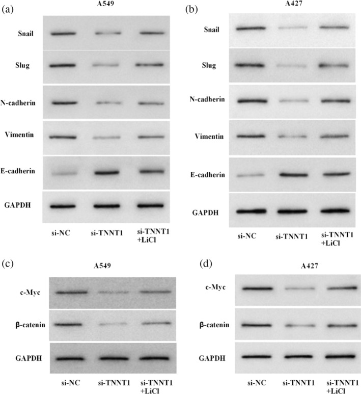 TNNT1 accelerates migration, invasion and EMT progression in lung cancer cells.