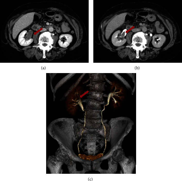 Acquired Hemophilia A Diagnosed Based on Gross Hematuria: A Case Report and Literature Review.