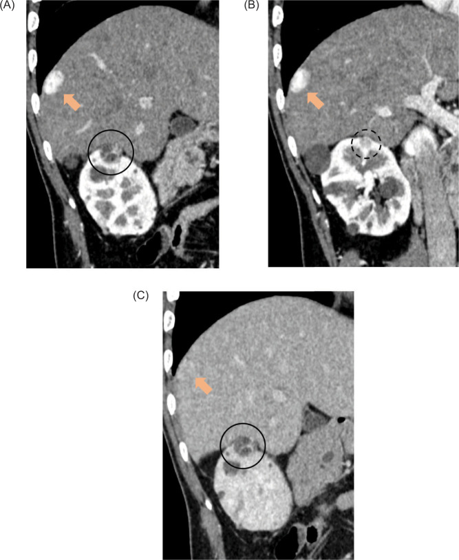 Clinical T1a Renal Cell Carcinoma with Solitary Diaphragmatic Metastasis in a Patient with von Hippel-Lindau Disease.