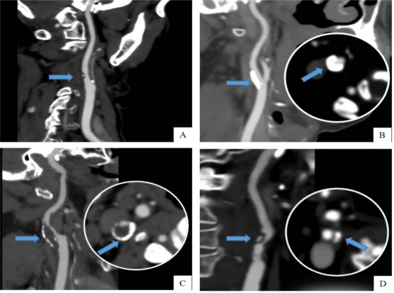 Prevalence and clinical implications of calcification in internal carotid artery stenosis: a retrospective study.