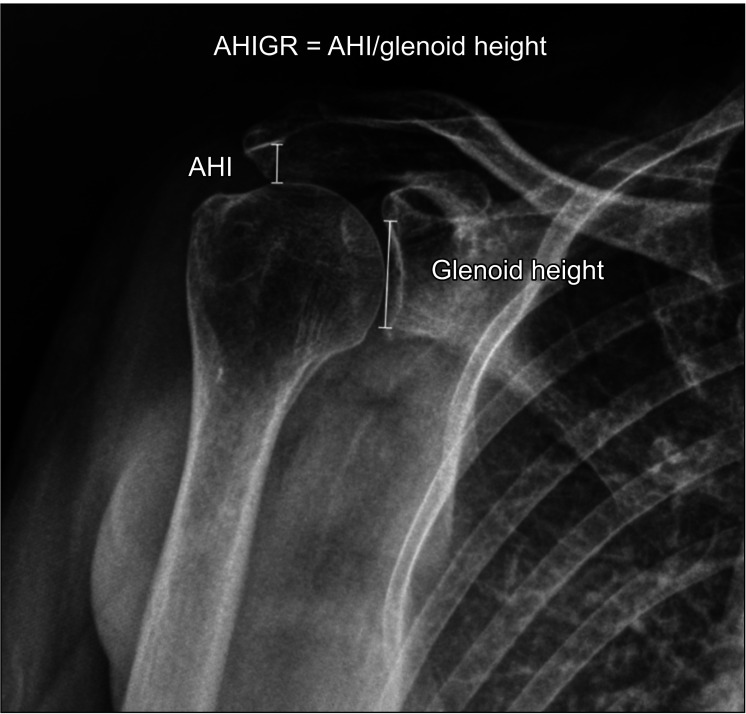 Transcending Patient Morphometry: Acromiohumeral Interval to Glenoid Ratio as a Universal Diagnostic Tool for Massive Rotator Cuff Tears.