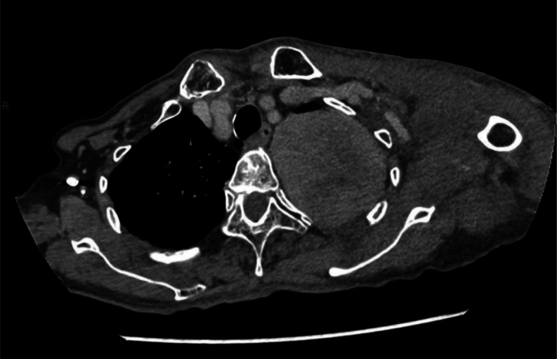 Non-islet cell tumor hypoglycemia that required immediate surgery after a long-term asymptomatic state: recommendation for early intervention.